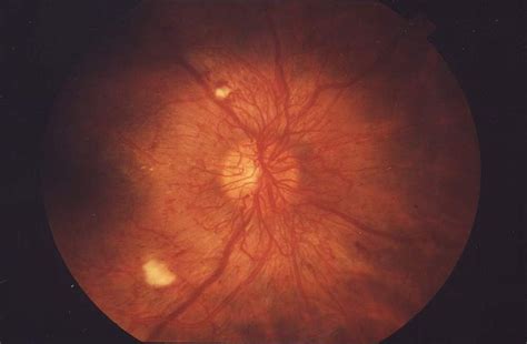 Diabetic retinopathy physical examination - wikidoc