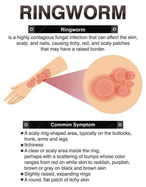 Free Vector | Informative symptoms of ringworm