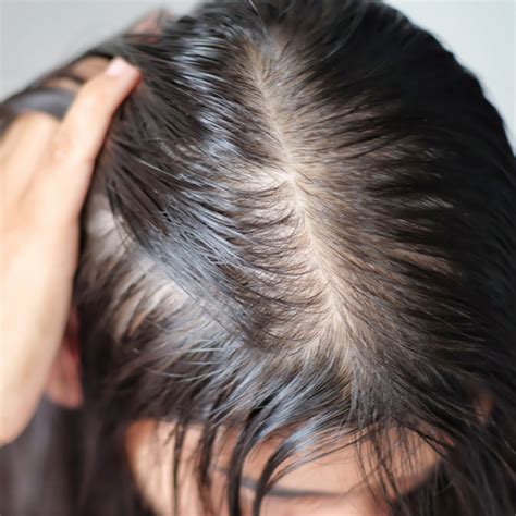 treatment of androgenetic alopecia Archives - ACTIV LIVING COMMUNITY