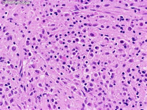 Webpathology.com: A Collection of Surgical Pathology Images