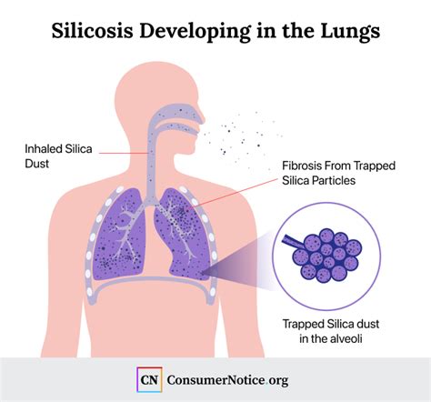 Silicosis: Symptoms, Causes, Treatment and Prevention