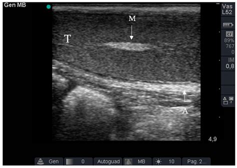 Mediastinum Testis Ultrasound