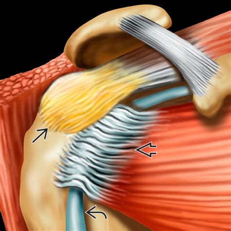 Rotator Cuff/Biceps Tendinosis | Radiology Key