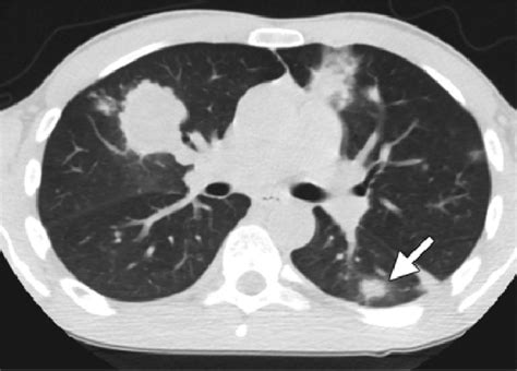 Aspergillus Pneumonia Ct Scan
