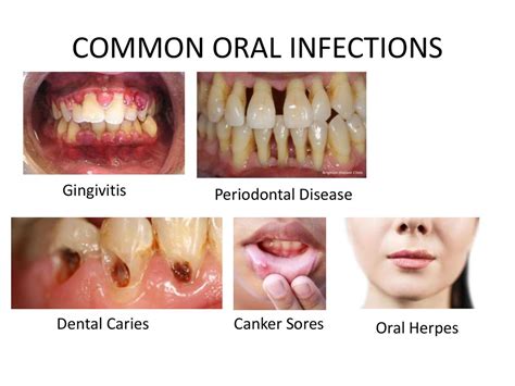 What is infection - online presentation