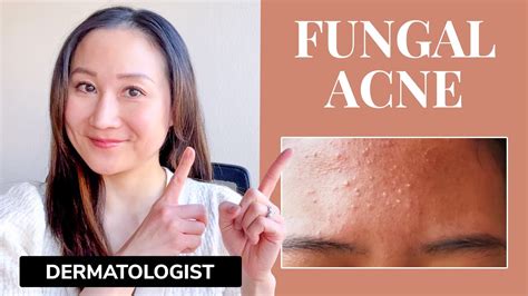 Fungal Acne