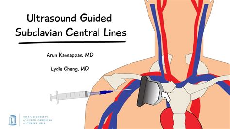 Ultrasound Guided Subclavian Central Lines -- BAVLS - YouTube