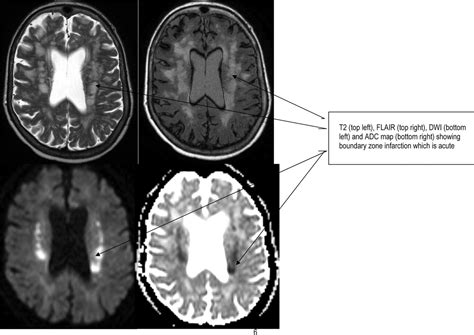 Hypoxic-ischaemic brain injury | Practical Neurology