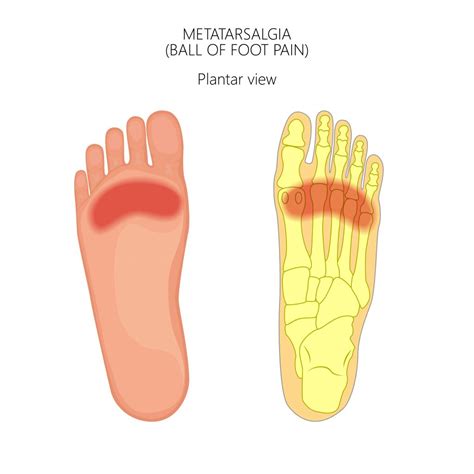 What Is Metatarsalgia? | Applied Biomechanics Orthotics & Bracing Guelph