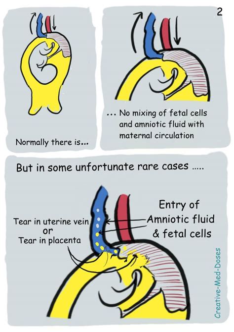 Amniotic Fluid Embolism - Creative Med Doses