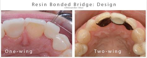 Resin Bonded Bridge: Minimally Invasive Option for Tooth Replacement - Shor Dental