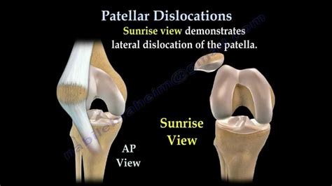 Patella dislocation - recurrent or injury related - Max Superspecialty ...