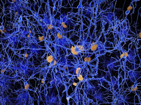 The Neuropathological Hallmarks of Alzheimer’s Disease - Altoida