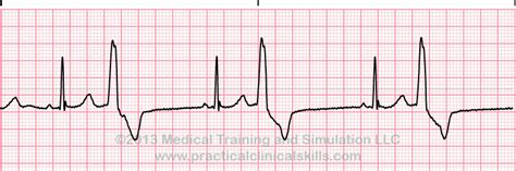 EKG