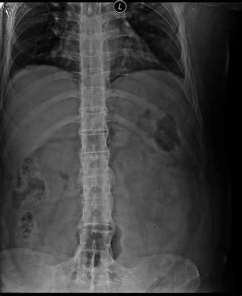 Bamboo Spine on X-ray in a patient with Ankylosing - MEDizzy