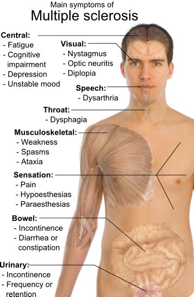 Multiple Sclerosis Prognosis Overview - Symptoms of Health