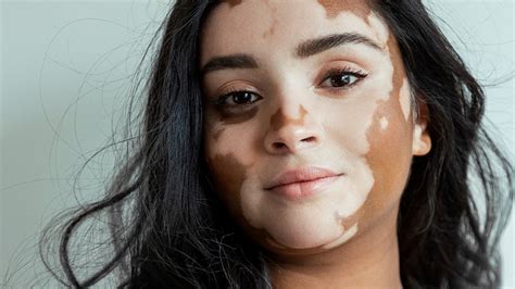 Onella Muralidharan on embracing difference and her vitiligo | body+soul