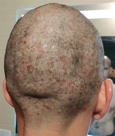 Scalp Acne/Folliculitis (Pictures) - Page 2 - General acne discussion ...