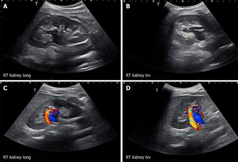 Normal Kidney Ultrasound