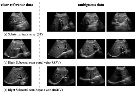 Real-Time Deep Recognition of Standardized Liver Ultrasound Scan Locations