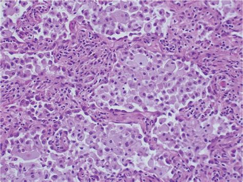 Microscopic section of lung parenchyma. Morphological pattern of... | Download Scientific Diagram