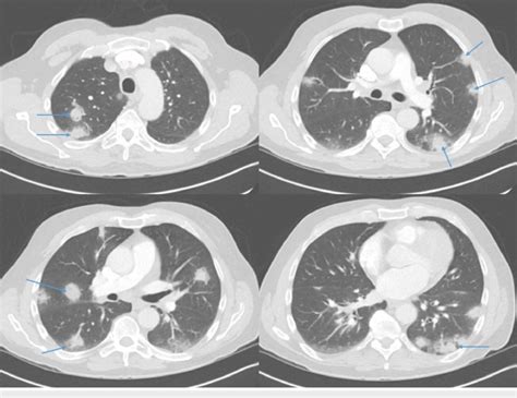 CT scan of the chest revealing numerous lung nodules seen in both lungs ...