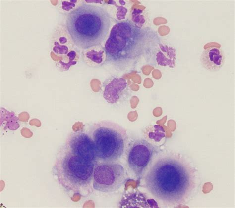 Mesothelial cells | Cell, Medical laboratory, Hematology