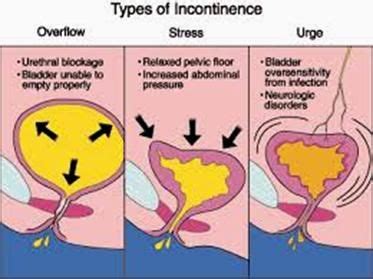 flaccid bladder - Google Search | Nursing mnemonics, Nursing tips, Internal medicine