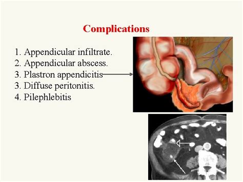 ACUTE APPENDICITIS Koray Topgl MD Prof Department of