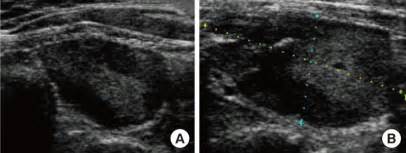 Ultrasonographic findings of a parathyroid adenoma at a local hospital... | Download Scientific ...