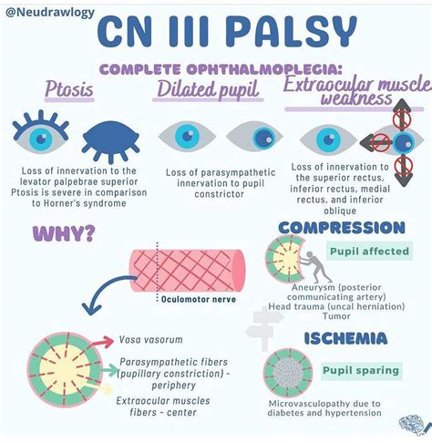 Oculomotor Nerve Palsy:... - Ophthalmology-Notes And Synopses