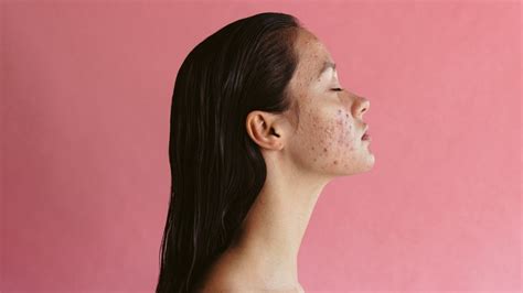 Acne Symptoms, Causes & Treatments | SELF