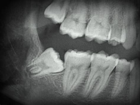 Wisdom Teeth | Western Pennsylvania Oral and Maxillofacial Surgery