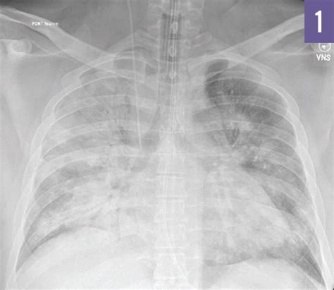 Pitfalls in the Management of Mechanical Ventilation: ARDS and Hypermetabolic States | Consultant360