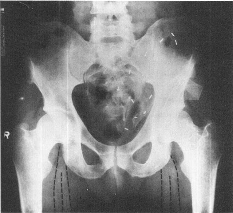 X-ray of pelvis following pancreas transplantation. Surgical clips... | Download Scientific Diagram