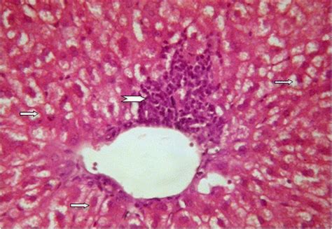 The liver from the treatment NCD showing hydropic degeneration in... | Download Scientific Diagram