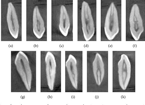 Figure 1 from Root Canal Morphology of Permanent Maxillary and ...