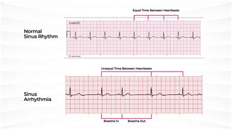 What is Sinus Arrhythmia? Symptoms, Causes & Treatment