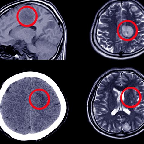 Hydrocephalus Treatment in St James: Hydrocephalus Treatment