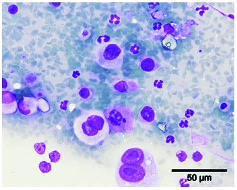 Fine needle aspiration cytology of the right inguinal mammary lesion.... | Download Scientific ...