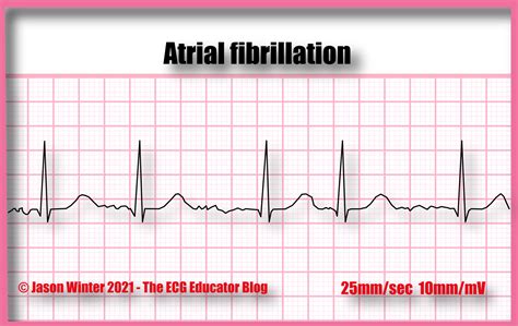 Atrial Fibrillation Ecg
