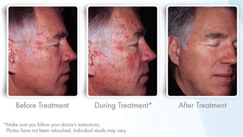 Photodynamic Therapy - Minars Dermatology