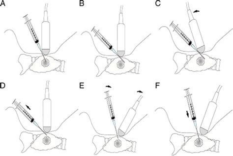 US-guided Fine-Needle Aspiration of Thyroid Nodules: Indications ...