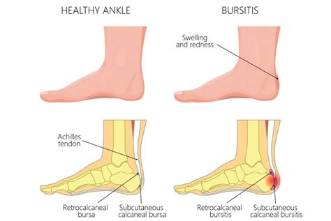 Bursitis. What is it, do I have it and what can I do about it?