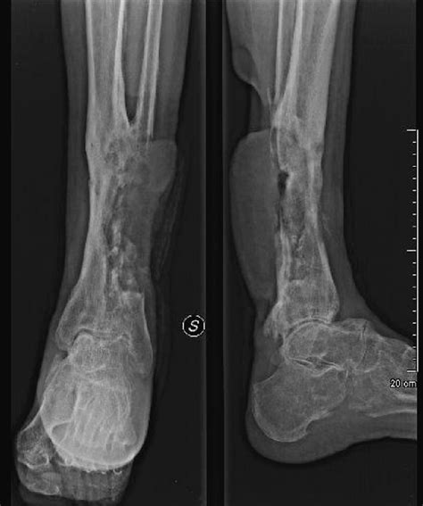 Aggressive, Metastatic Squamous Cell Carcinoma After a 46-Year-Old ...