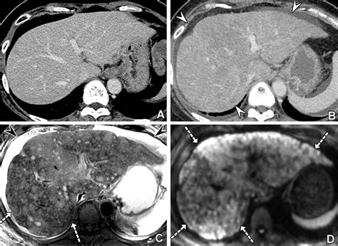 Liver Metastases: Correlation between Imaging Features and ...