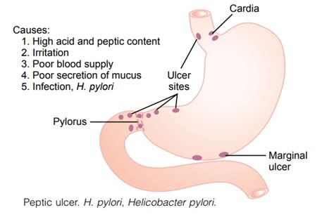 Peptic Ulcer - Disorders of the Stomach