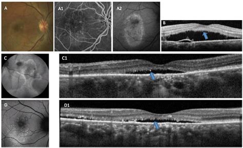 Central Serous Chorioretinopathy: A Review Fung 2023, 49% OFF