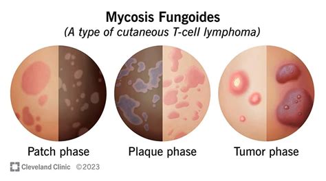 Mycosis Fungoides Treatment Market 2023 Statistics and Growth Factors