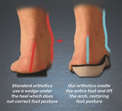 Arthritis Pain? Custom Orthotic Foot & Arch Supportive Insoles Can Help!